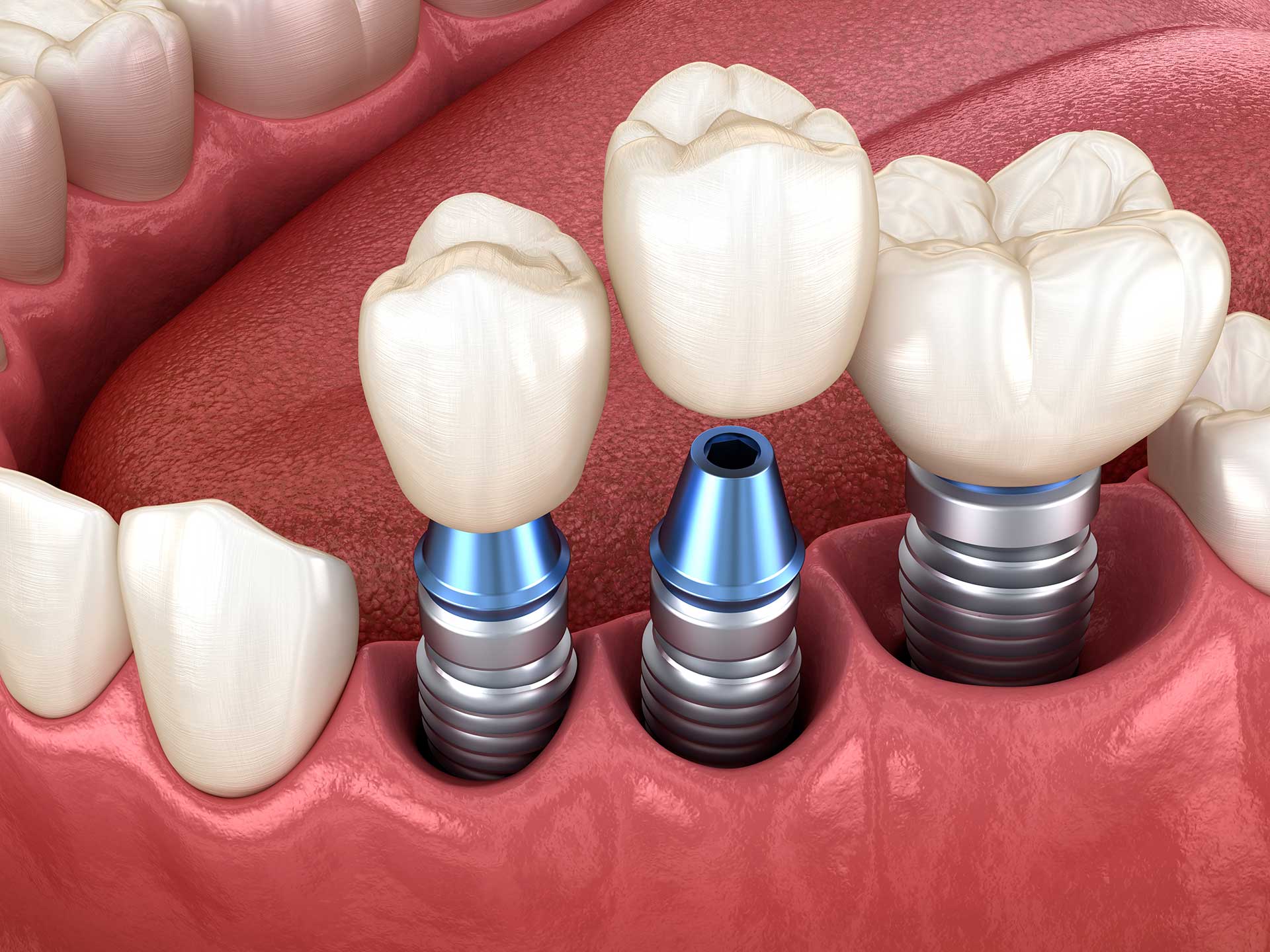 Complete Guide to Dental Implants