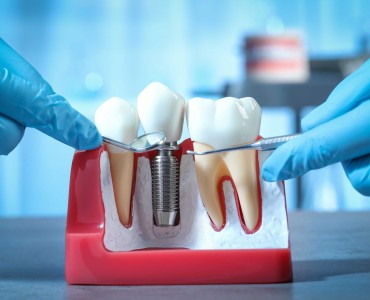 Curiosities About Implant Treatment