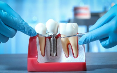 İmplant Tedavisi Hakkında Merak Edilenler