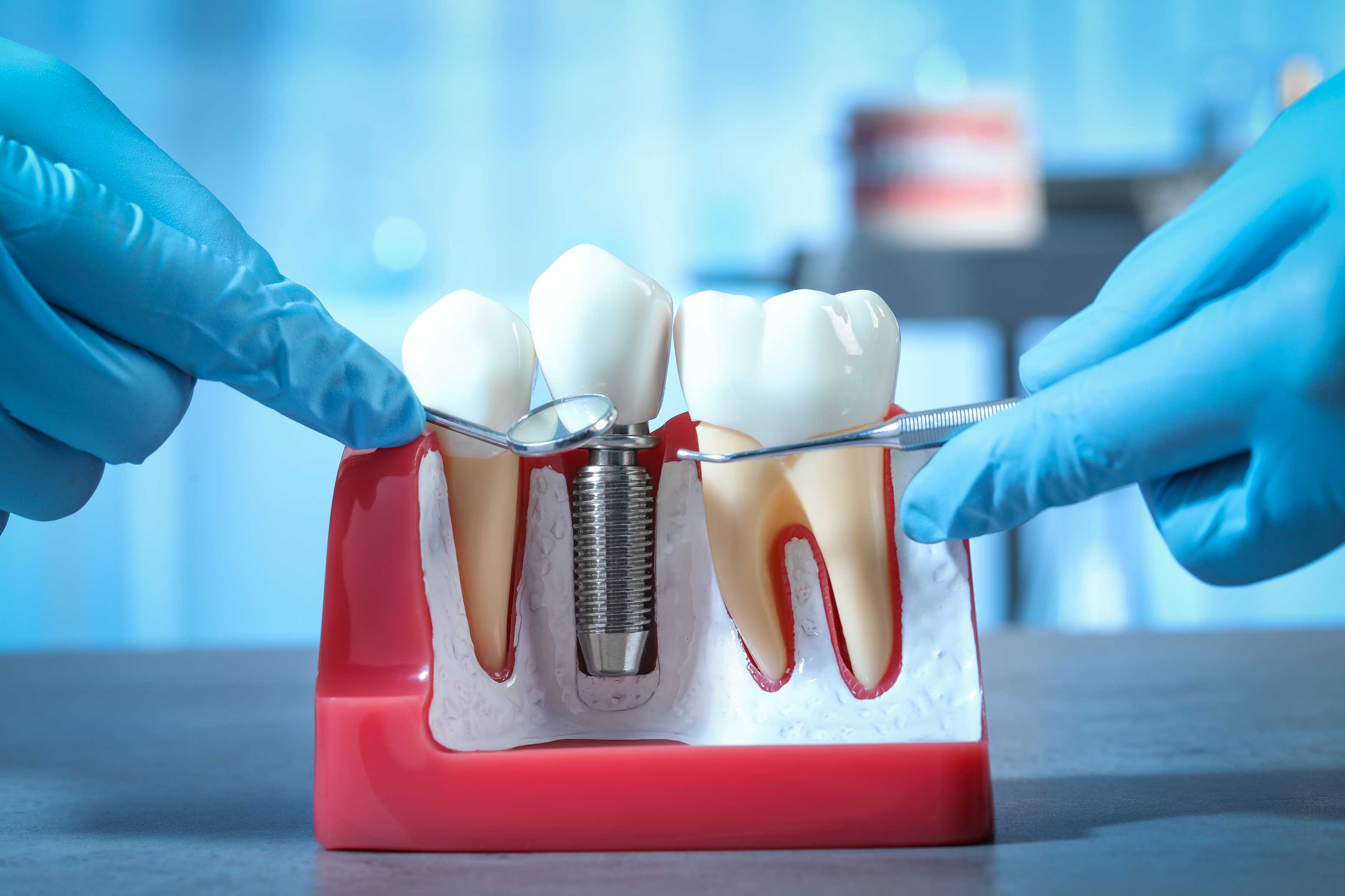 Curiosities About Implant Treatment