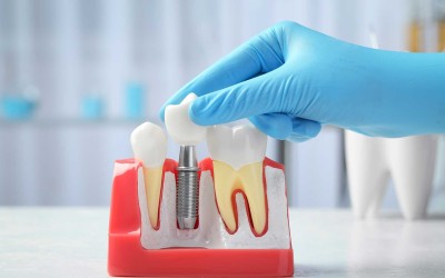 İmplant Tedavisi: Sağlıklı Gülüş için Kalıcı Çözüm