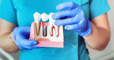 Implant Dental Treatment 
