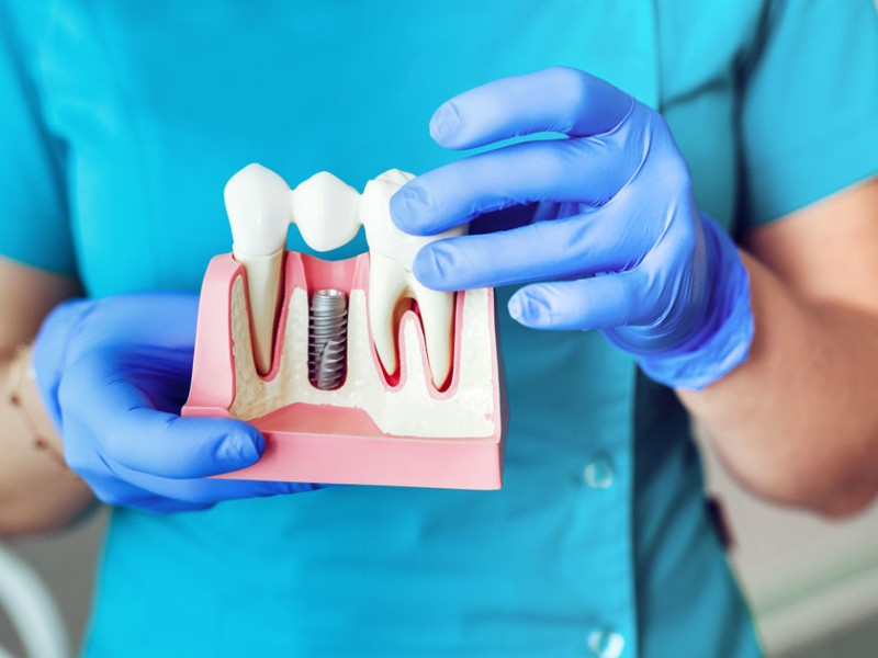 Implant Dental Treatment 