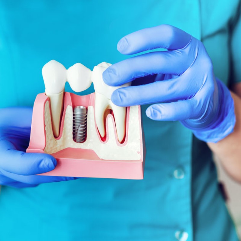 Implant Dental Treatment 