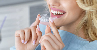 Invisalign Treatment