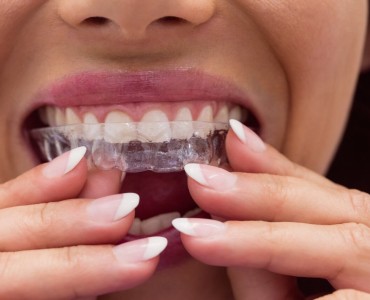 Invisalign Tedavisi ile Tel Takmadan Düz Dişler