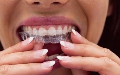 Invisalign Tedavisi ile Tel Takmadan Düz Dişler