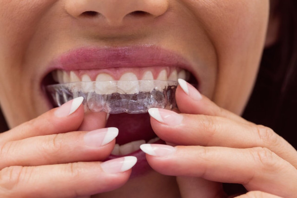 Invisalign Tedavisi ile Tel Takmadan Düz Dişler