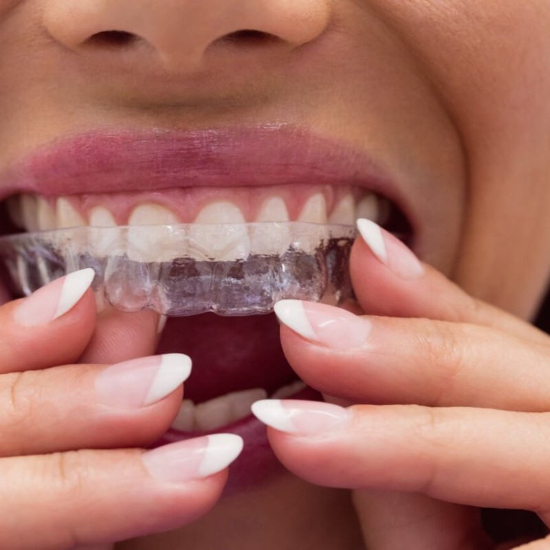 Invisalign Tedavisi ile Tel Takmadan Düz Dişler