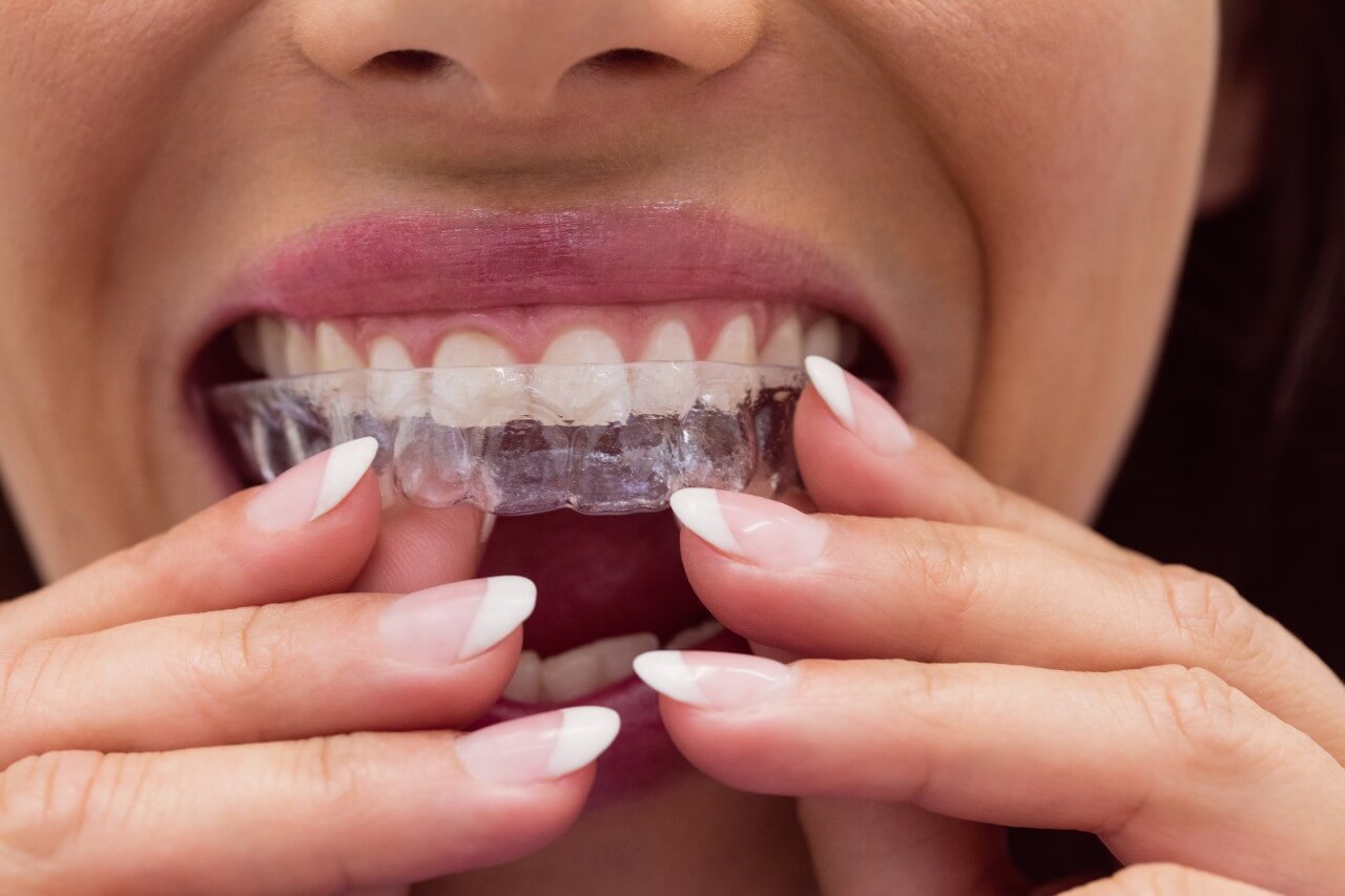 Invisalign Tedavisi ile Tel Takmadan Düz Dişler