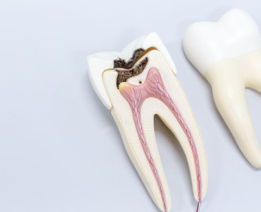False Facts About Root Canal Treatment