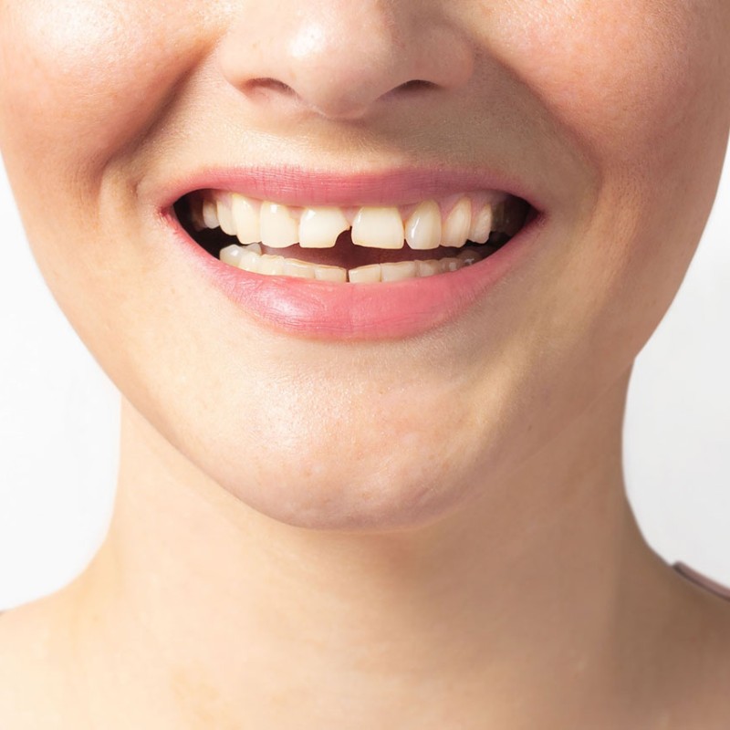 Everything You Need To Know About Broken Tooth Treatment