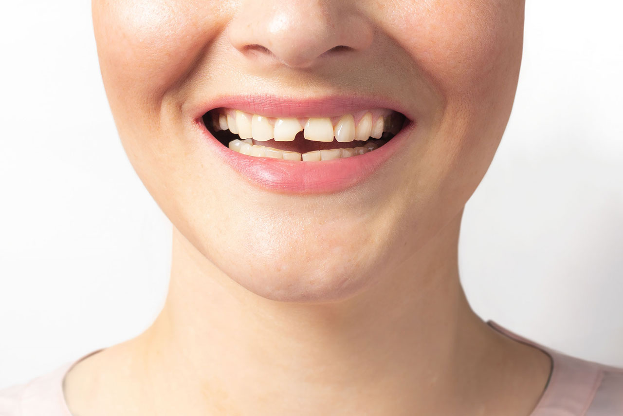 Everything You Need To Know About Broken Tooth Treatment