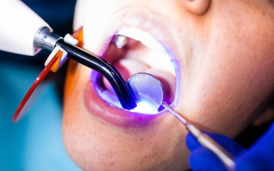 Kompozit Dolgu Nedir? Nasıl Yapılır?