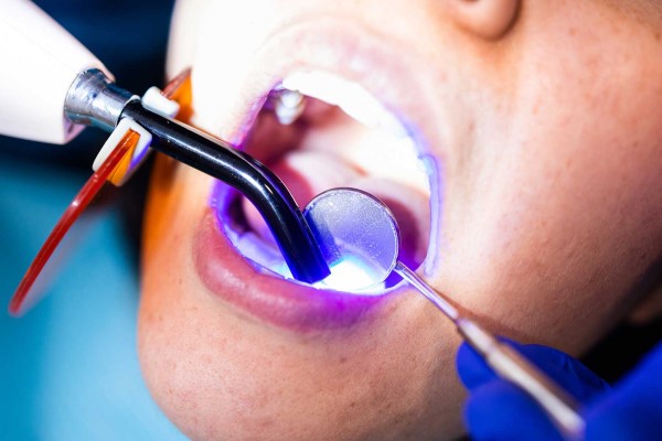 Kompozit Dolgu Nedir? Nasıl Yapılır?