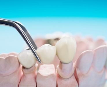 What is Dental Bridge? How is it done?