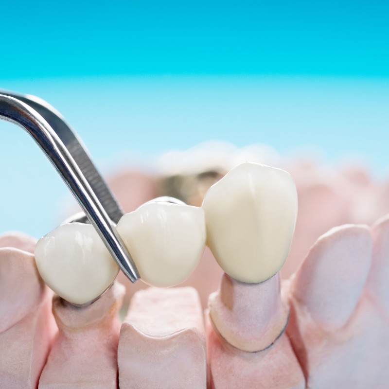 What is Dental Bridge? How is it done?