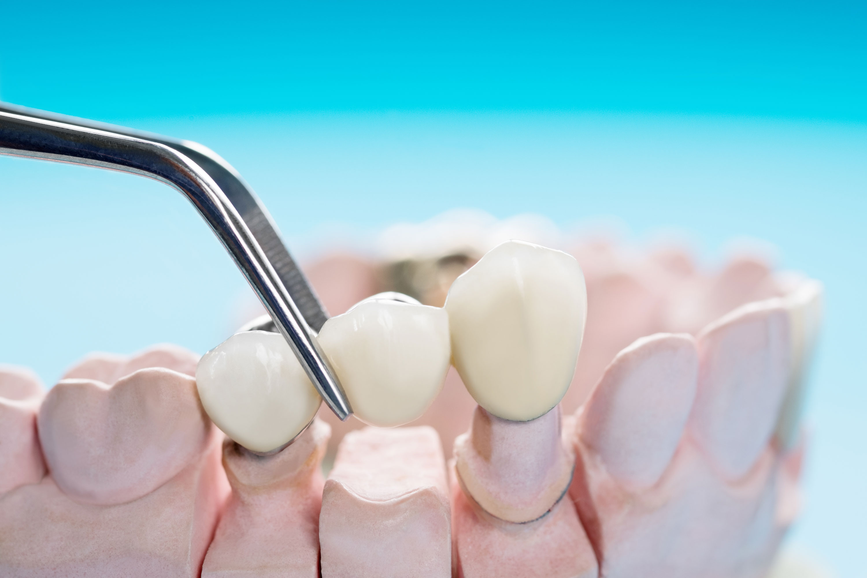 What is Dental Bridge? How is it done?