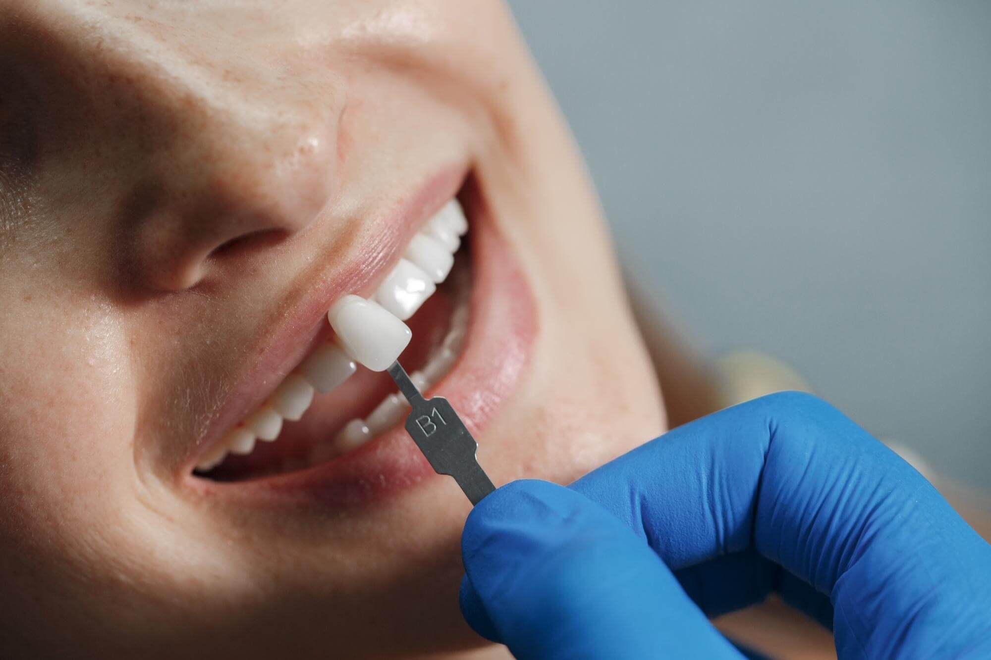 Lamine Diş Kaplamada Sık Sorulan Sorular