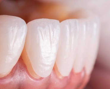 Lamine Veneerler Nedir ve Neden Tercih Edilmelidir?