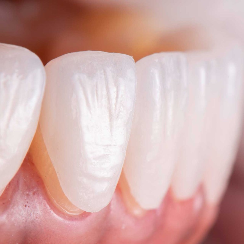 Lamine Veneerler Nedir ve Neden Tercih Edilmelidir?