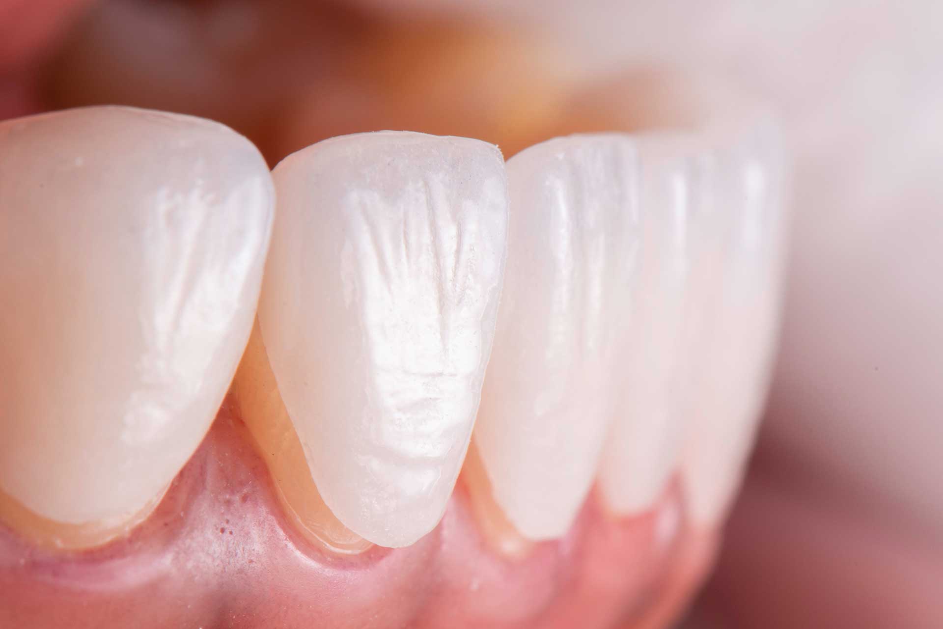 What Are Laminate Veneers and Why Should They Be Preferred?