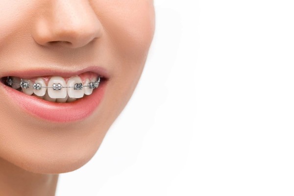 Ortodonti Bölümü Hangi Hastalıklarla İlgilenir?