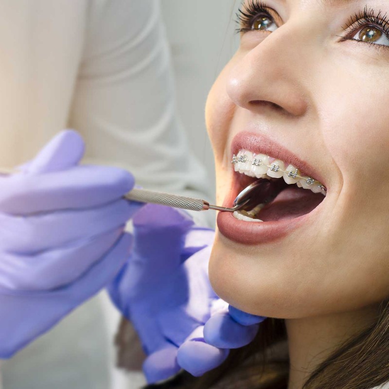 Ortodonti Tedavisi Hakkında Bilmeniz Gerekenler