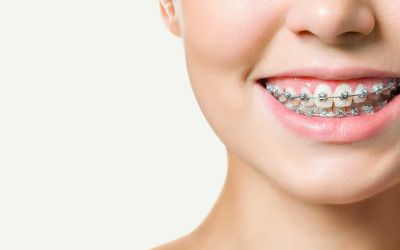 Ortodontik Tedavi Sürecinde Nelere Dikkat Edilmeli?