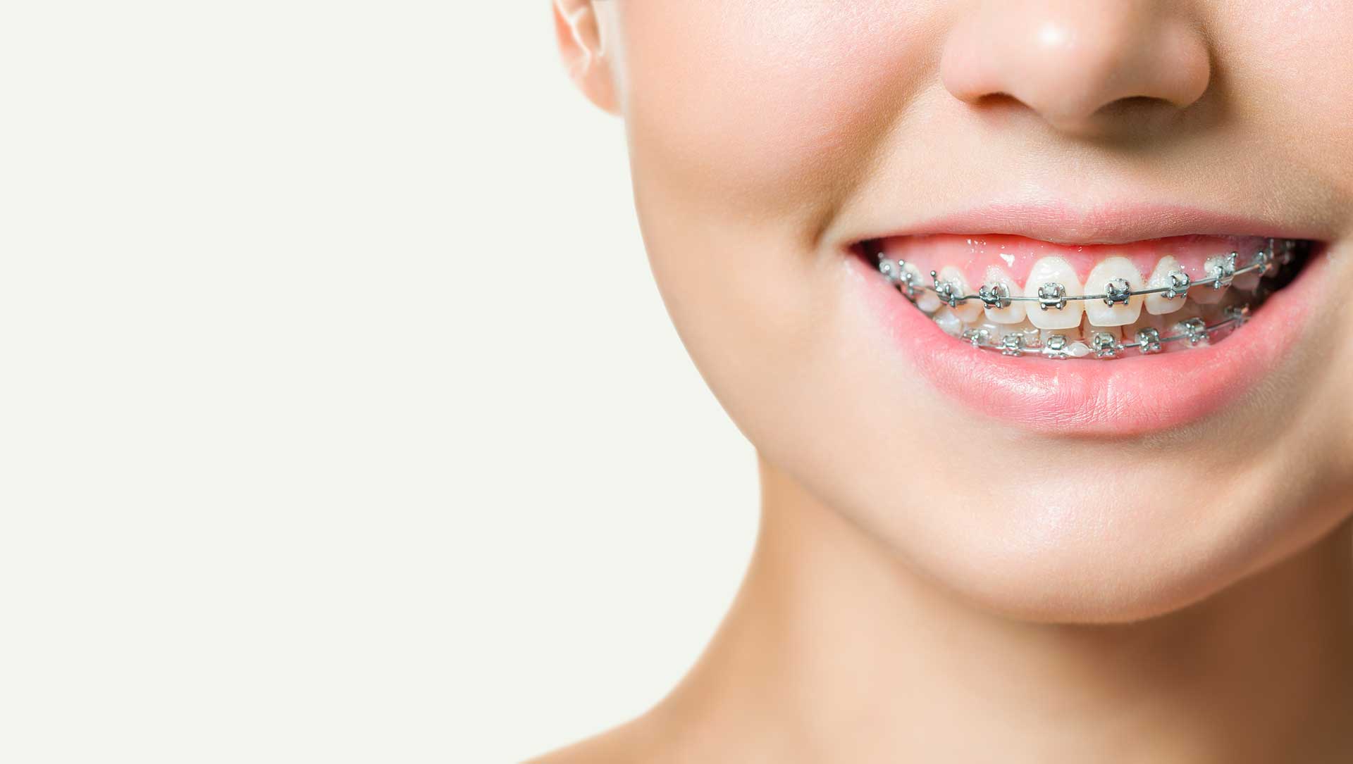 What to Consider During the Orthodontic Treatment Process?