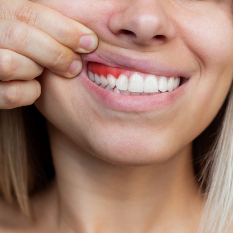 Periodontoloji (Diş Eti Hastalıkları)