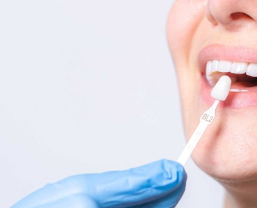 Porcelain Dental Veneers: What Are They? Advantages and Disadvantages