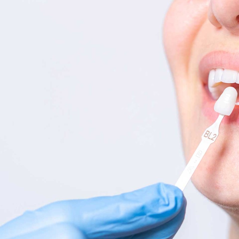Porselen Diş Kaplama Nedir? Avantajları ve Dezavantajları