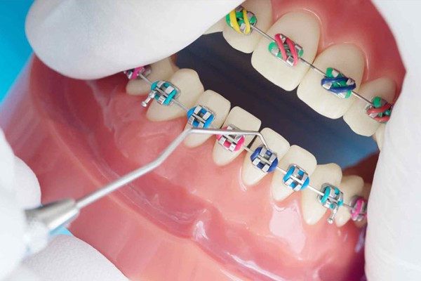 Renkli Diş Telleri Nedir?