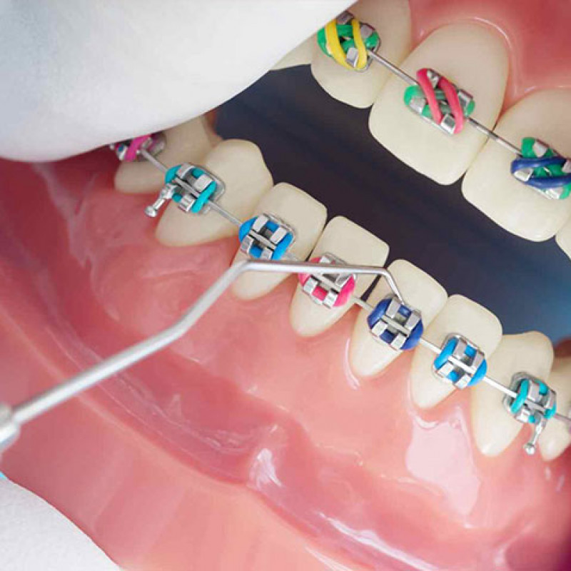 What Are Color Braces?