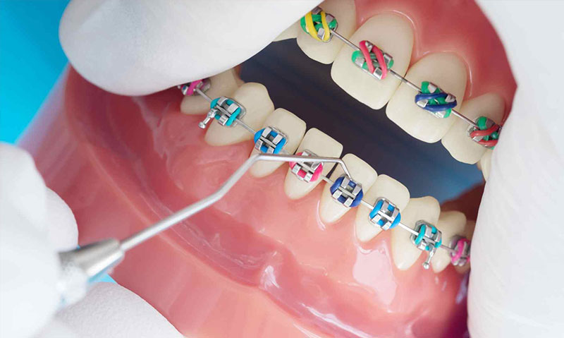 What Are Color Braces?