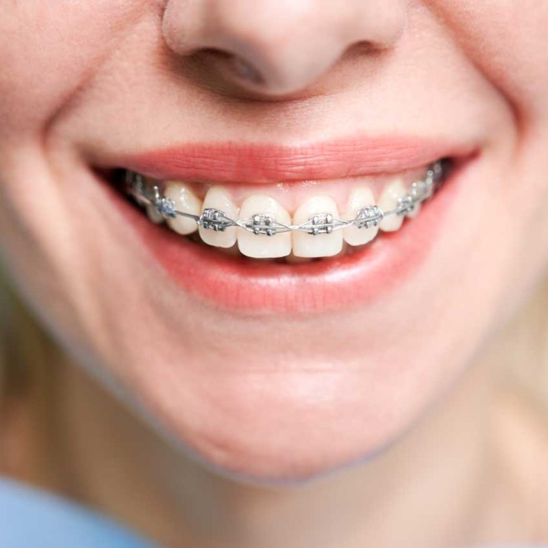 Ortodonti Tedavisi Sonrası Retainer Teli (Pekiştirme Tedavisi) Neden Önemli?