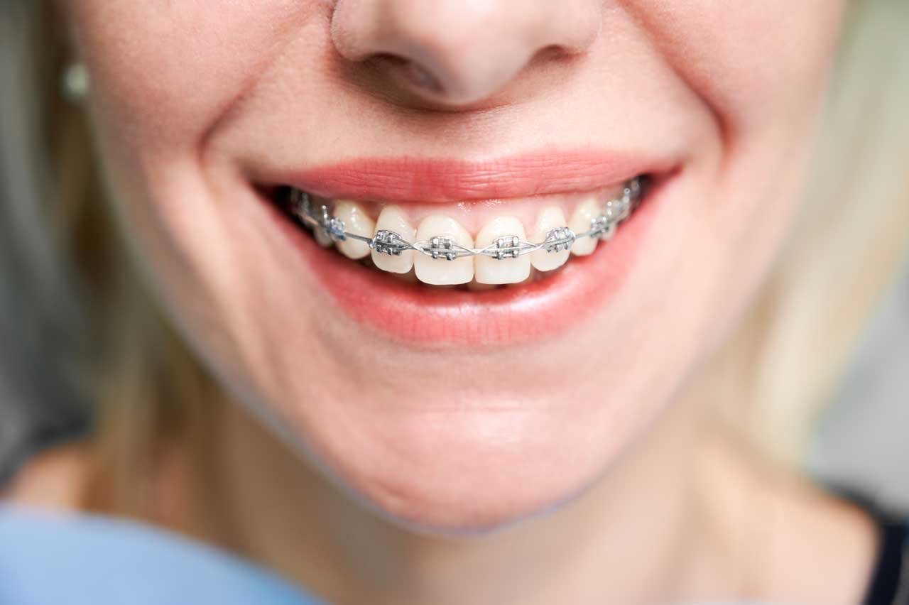 Why is Retainer (Reinforcement Treatment) Important After Orthodontic Treatment?