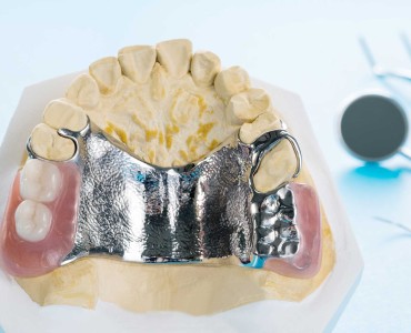 What is a Subperiosteal Implant?