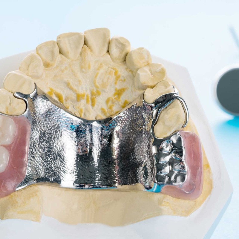 Subperiostal İmplant Nedir?