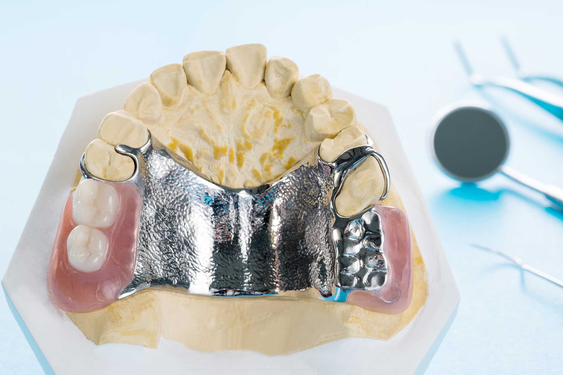 What is a Subperiosteal Implant?