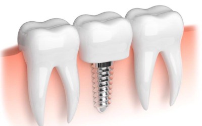 Implant Treatment In Turkey
