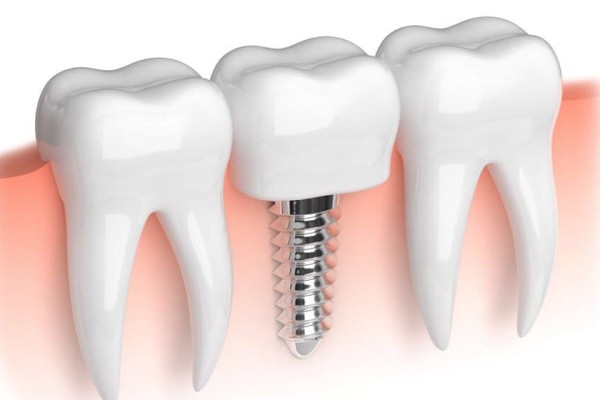 Türkiye'de İmplant Tedavisi