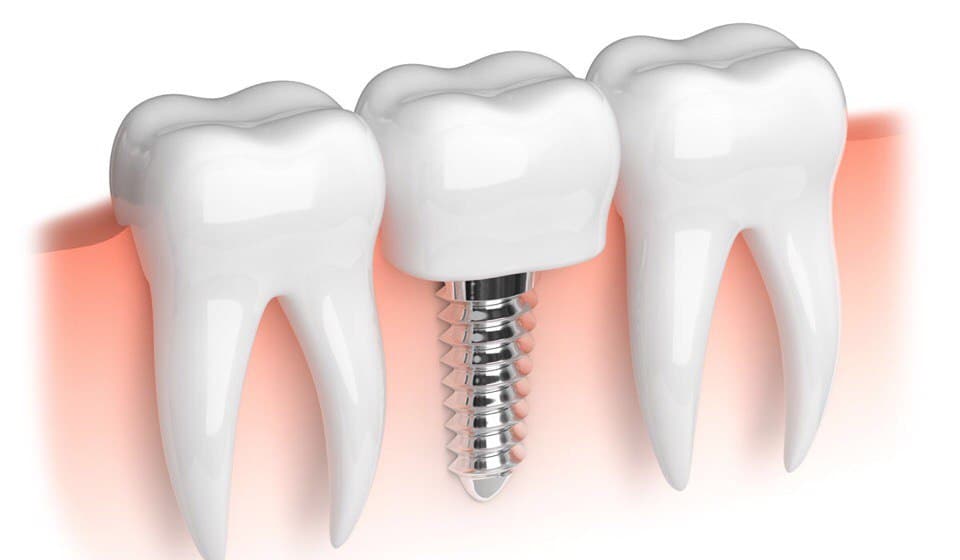 Implant Treatment In Turkey