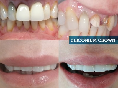 Zirkonyum Diş Kaplama